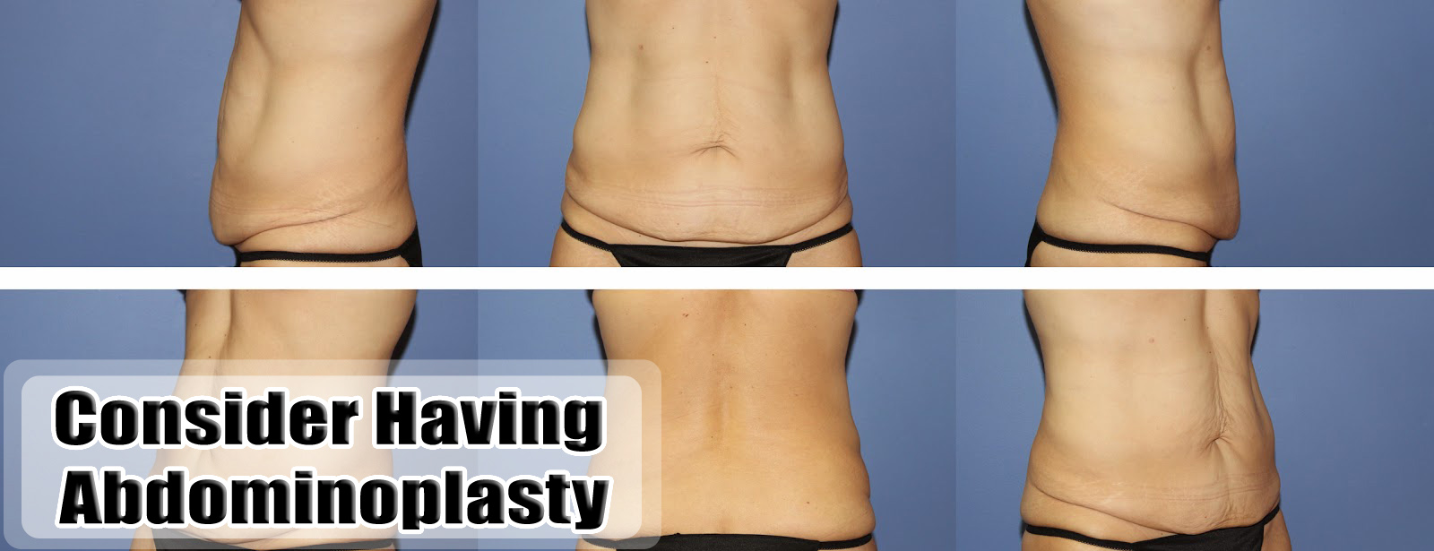 Why You Need to Consider Having Abdominoplasty