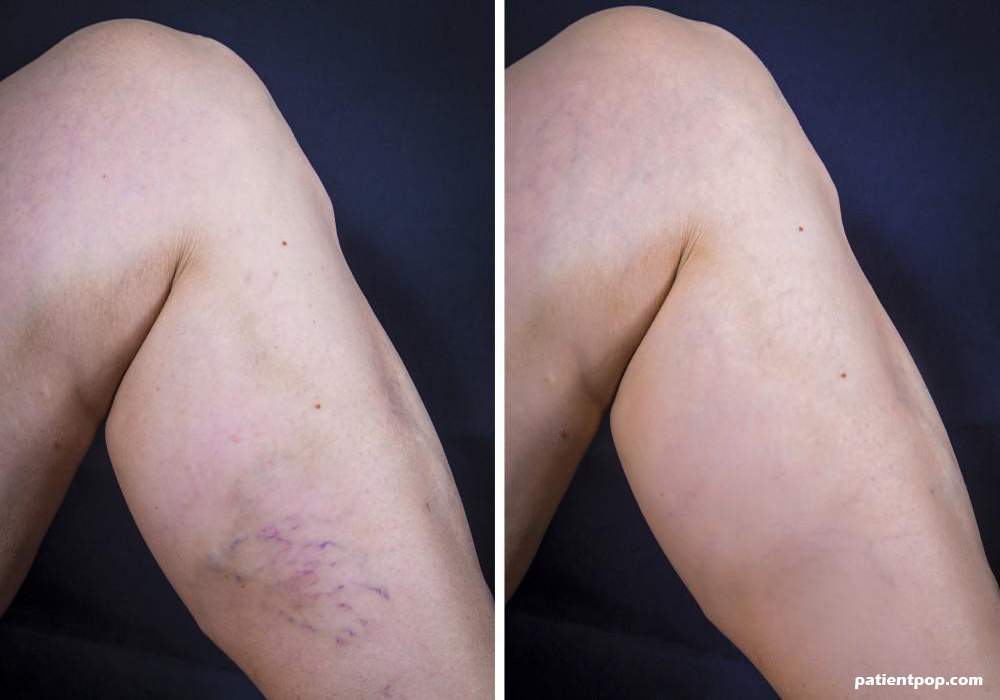 Overview Of Treatment Options For Unsightly And Uncomfortable Varicose Veins