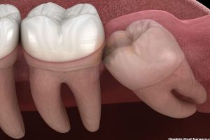 Human Dental Structure and the Wisdom Teeth Removal