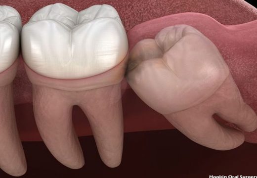 Human Dental Structure and the Wisdom Teeth Removal