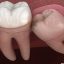 Human Dental Structure and the Wisdom Teeth Removal