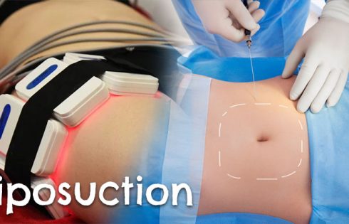 Liposuction without surgery. The whole truth about laser lipolysis