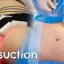 Liposuction without surgery. The whole truth about laser lipolysis