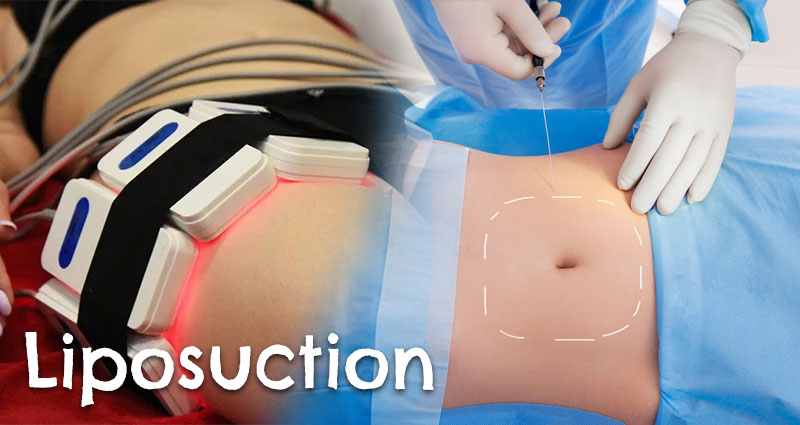 Liposuction without surgery. The whole truth about laser lipolysis